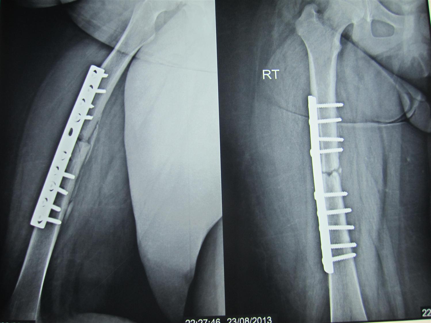 Femoral Shaft Fracture